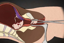 引产手术视频,医学视角下的生命转折